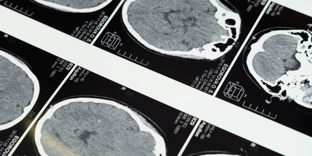 A student deeply focused on analyzing brain scan data, connecting theoretical knowledge with practical neuroimaging insights.